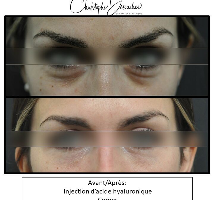 Injection of hyaluronic acid dark circles