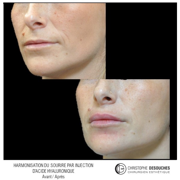 Augmentation des lèvres par injection d'Acide Hyaluronique : avant / après